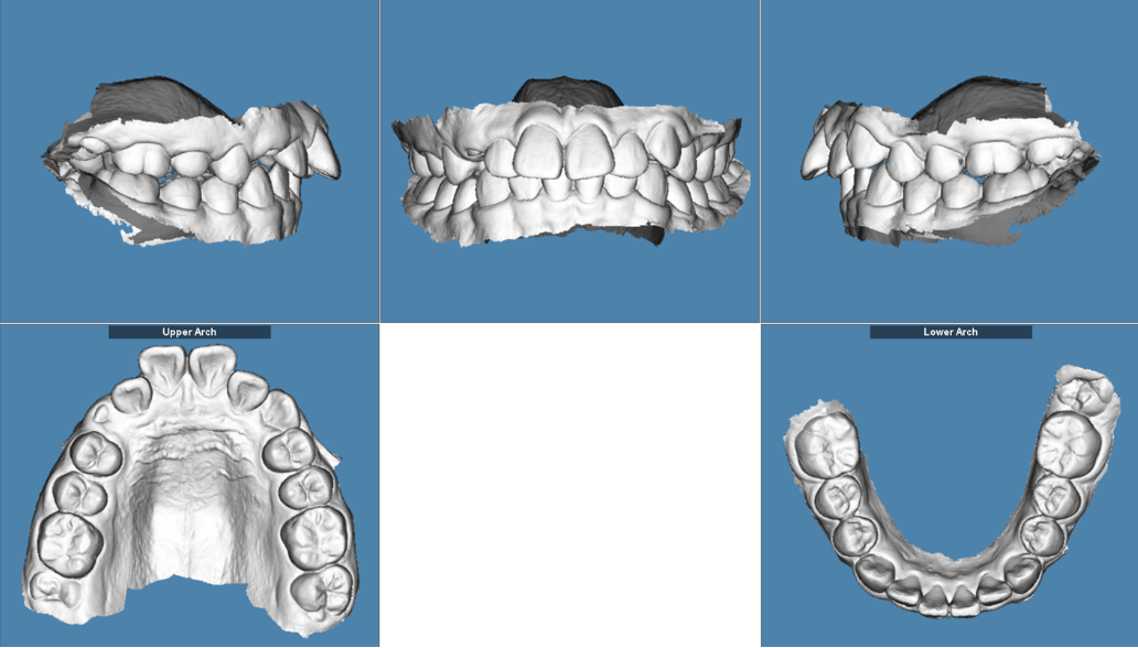 <p>What is the Angle's classification for this patient?</p>