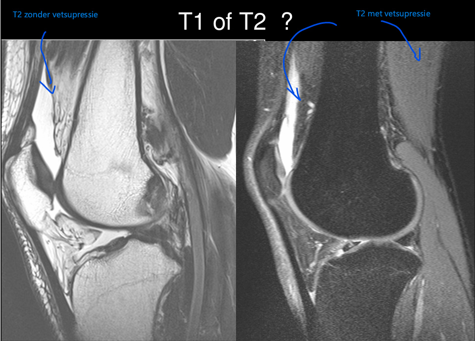 <ul><li><p>Links: T1 (vet is wit, vetkwabje van Hoffa is wit)</p></li><li><p>Rechts: T2 met vetsupressie (vet is donkergrijs) en prepatellaire bursitis (wit)</p></li></ul><p></p>