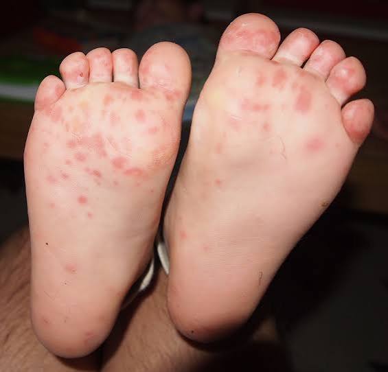 <p>what other complications can occur with <strong>hand, foot, and mouth disease</strong>?</p>