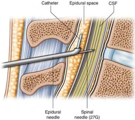 <p>No medications are given through the spinal needle</p>