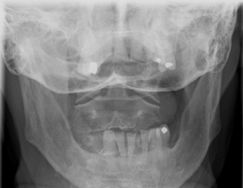 <p><span>Which of the following statements are correct regarding the Odontoid radiograph below?</span></p><ol><li><p><span>The atlantoaxial articulation is well demonstrated</span></p></li><li><p><span>The odontoid process is incompletely visualized</span></p></li><li><p><span>More flexion is required to move upper incisors inferiorly</span></p></li><li><p><span>More extension is required to move base of skull more inferiorly</span></p></li></ol><p></p>