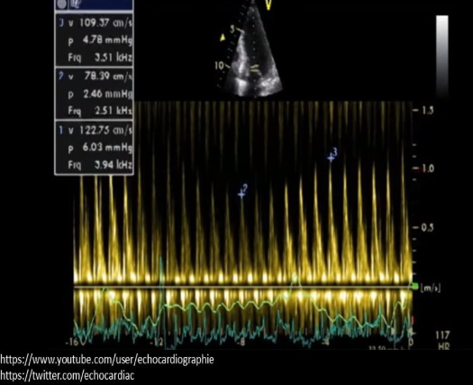 <p>this doppler tracing is consistent with what cardiac abnromality? </p>