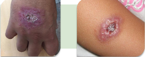 <p>La infección se limita al sitio de inoculación, generando una lesión única con aspecto verrugoso, nodular o ulcerado. No existe diseminación linfática, lo cual refleja una respuesta inmune eficaz. </p>