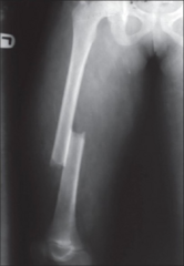 <p>Transverse Midshaft Femoral fracture with associated medial displacement</p>