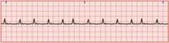 <p>No organized contraction of the atria, no identifiable P waves, only fibrillatory waves with a normal QRS duration, possible blood-clot formation</p>