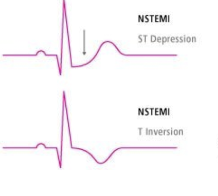 <p>A heart attack caused by a partial blockage that damages the heart muscle, confirmed by elevated troponin levels without ST-elevation</p><p>NSTEMI vs unstable angina</p><ol><li><p>Degree of ischemia that results</p></li><li><p>whether damage causes release of myocardial necrosis biomarkers (troponin, creatine, kinase-MB, myoglobin)</p></li></ol><p>Pathogenesis </p><ul><li><p>atherosclerotic plaque rupture </p></li><li><p>coronary artery vasoconstriction </p></li><li><p>myocardial oxygen demand and supply imbalance </p></li></ul><p>Risk Factors</p><ul><li><p>cigarette smoking (vasospastic angina)</p></li></ul><p>Clinical Manifestations </p><ul><li><p>presentation of unstable angina and NSTEMI similar </p></li><li><p>severe chest pain lasting more than 20min </p></li></ul><p>Emergency medical services needed in cases of </p><ul><li><p>chest pain</p></li><li><p>sever dyspnea</p></li><li><p>Syncope (loss of consciousness or fainting) or presyncope episode (lightheadedness, nausea, and weakness)</p></li><li><p>Palpitations </p></li></ul><p>Dignosis</p><ul><li><p>ECG</p></li><li><p>Serial cardiac tropnins </p></li></ul><p>Treatment </p><ul><li><p>supplemental O2</p></li><li><p>Short-acting sublingual nitroglycerin</p></li><li><p>IV nitroglycerin</p></li><li><p>Morphine sulfate</p></li><li><p>Oral beta blockers </p></li><li><p>High intensity statin therapy </p></li><li><p>Antiplatelet therapy and anticoagulation therapy </p></li><li><p>Invasive strategies </p></li></ul><p></p>
