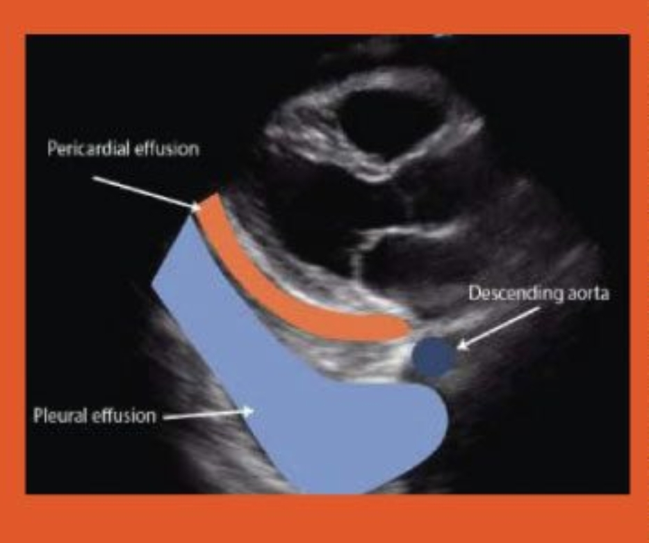 <p>Pericardial Effusion </p>