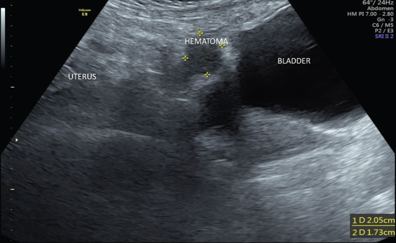 <ul><li><p>anechoic w/ ill-defined borders</p></li><li><p>very small (<1cm) to very large (>15cm)</p></li><li><p>complex masses b/c of the blood components clotting, internal septations, or debris within the hematoma</p></li></ul><p></p>