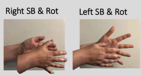 <p>Physiologic. 2 parallel vertical axises and 1 AP axis. Sphenoid and occiput will sidebend in opposite directions around the parallel vertical axises but rotate in the same direction around the AP axis.</p><p>For a right sidebending and rotation: Right hand will move away from you (towards pt) with fingers spreading further apart. Left hand will move closer to you (away from pt) with fingers approximating/coming together</p><p></p><p>Extra Info for Comp:</p><p>Named after the side of convexity or where the hand “feels fuller.” This “fullness'“ comes from the widening of the sphenoid and occiput (midline bones).</p><p>Ex: in a right sidebending and rotation, the sphenoid and occiput will widen on the right side</p>