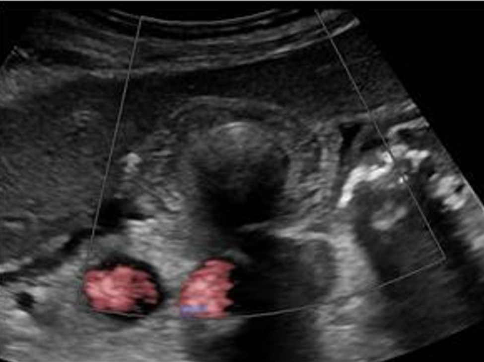 <p>What is the most likely cause for the biliary findings on the image? </p><p>a. hepatitis</p><p>b. acute cholecystitis</p><p>c. congestive heart failure</p><p>d. pancreatitis</p>