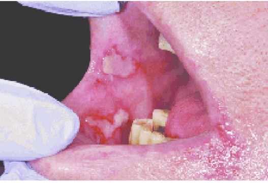 <p>BN XUẤT HIỆN VẾT ĐỎ, LOÉT VÀ ĐAU </p><p>CHẨN ĐOÁN ?</p>