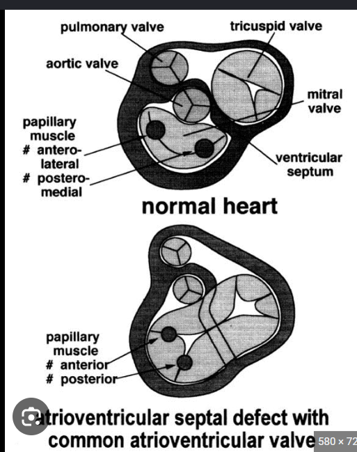 <p>The LV papillary muscles rotate counterclockwise to approximately the <strong>3-o’clock and 7-o’clock positions</strong>. This rotation may contribute to <strong>LVOT obstruction</strong>.</p><p>(in PSAX can see this)</p>