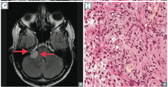 <p>Neurofibromatosis type 2</p><p>S-100+, cerebellopontine angle</p>