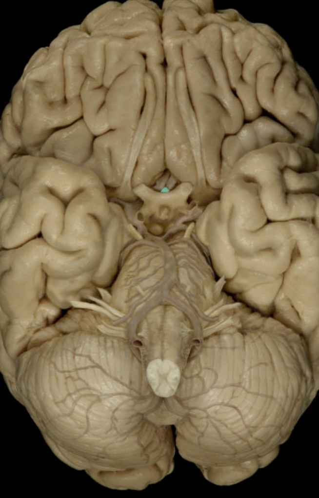 <p>Identify the artery to the brain (circle of willis)</p>