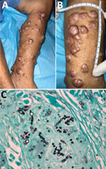 <ul><li><p>kelloidal blastomycosis</p></li><li><p>common in native/ indegnous groups</p></li><li><p>incredibly painful</p></li></ul><p></p>