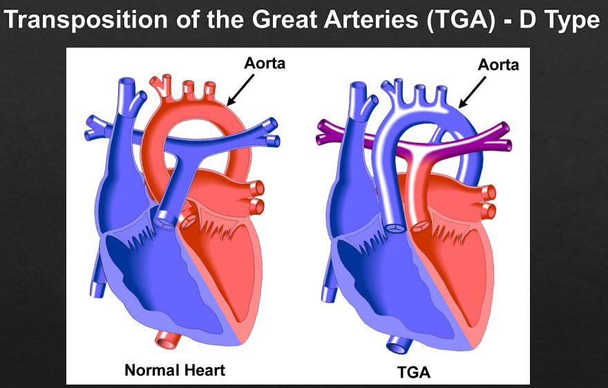 <p>Complex Cyanotic CHD</p><p>Aorta connects to RV rather than LV, receives cyanotic blood, whilst pulmonary arteries connect to LV</p><p><strong>RF</strong>:</p><p><strong>Sx</strong>: Cough, noisy breathing/breathing difficulties, failure to thrive/LOW, newborn resp. distress</p><ul><li><p>Severe Neonatal Cyanosis unresponsive to O2 (due to parallel circulations → survival depends on mixing via ASD, VSD, or PDA)</p></li></ul><p><strong>Ix</strong>: Clinical Exam, CXR, ECG, Echocardiogram (aorta arising from RV and pulmonary artery from LV)</p><p><strong>Mx</strong>: requires early surgical intervention (transposition repair - switches Aorta and Pulmonary Arteries, Atrial septostomy to improve mixing)</p><ul><li><p>Maintain PDA w prostaglandin where needed</p></li></ul><p><strong>Cx</strong>: coronary insufficiency, ventricular dysfunction, arrhythmias</p>