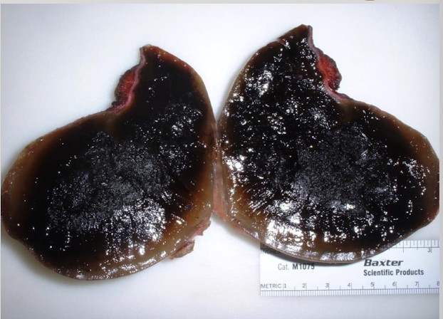 <p>abnormal accumulation of thick, inspissated mucus w/in gallbladder → gallbladder markedly distended &amp; filled w/ immobile bile &amp; mucus</p>