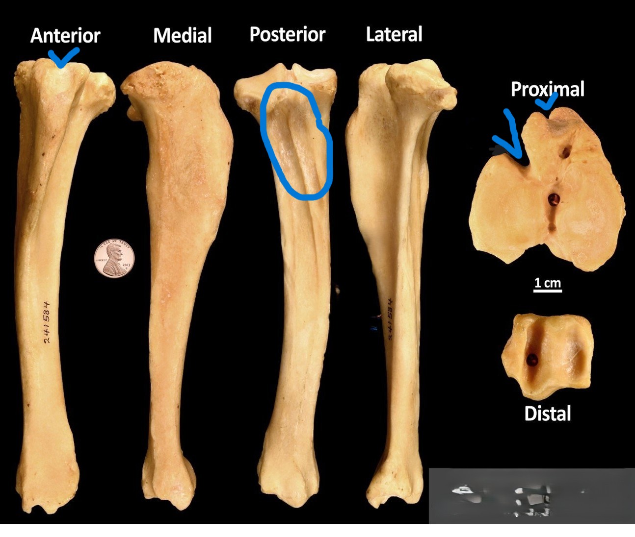 <ul><li><p>deep V-shaped notch</p></li><li><p>small anterior notch</p></li><li><p>deep depression on posterior side </p></li></ul><p></p><p>pig tibia </p><p></p>