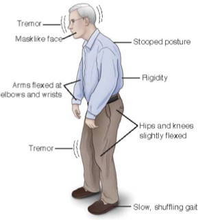 <p><mark data-color="yellow" style="background-color: yellow; color: inherit;">Progressive neurological disorder affecting movement, balance, coordination →</mark><span style="color: red;"><mark data-color="yellow" style="background-color: yellow; color: inherit;"> loss of dopamine</mark></span><mark data-color="yellow" style="background-color: yellow; color: inherit;"> producing brain cells</mark></p><p><strong><mark data-color="blue" style="background-color: blue; color: inherit;">Signs:</mark></strong></p><ul><li><p><span style="color: red;">resting tremor</span><span style="color: rgb(10, 9, 9);">, </span><span style="color: red;">muscle rigidity</span><span style="color: rgb(23, 21, 21);">,</span><span style="color: red;"> slow/loss move </span>(bradykinesia/akinesia), <span style="color: red;">postural instability</span> (falls), <span style="color: red;">shuffle &amp; wide gait</span></p></li></ul><p><strong><mark data-color="red" style="background-color: red; color: inherit;">Diagnostic: </mark></strong><span style="color: blue;">≥2 </span>cardinal symptoms are observed</p><p><strong><mark data-color="purple" style="background-color: purple; color: inherit;">Tx: </mark></strong>focus on controlling symp</p><ul><li><p><strong>(</strong><span style="color: red;"><strong>#1</strong></span><strong>) dopamine receptor agonist </strong>→ mimic dopamine</p><ul><li><p><u>side effect:</u> disorder of impulse control (gambling), LE edema, urinary freq</p></li></ul></li><li><p><strong>anticholinergics </strong>→ reduce tremor/drool (not used in older due to side effect)</p></li><li><p><strong>dopamine pre-cursor</strong> (cardidopa-levodioa) → for advanced stage</p></li></ul><p><strong><mark data-color="green" style="background-color: green; color: inherit;">Care:</mark></strong></p><ul><li><p>fall risk (short, deliberate steps), psychosocial (depression)</p></li></ul><p></p>