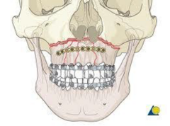 <p>- these fractures require stabilization with wires, arch bras or splinting by oral surgery</p><p>- DO NOT allow patient to eat or drink until fixation</p><p>- open fractures warrant prophylactic abx</p>