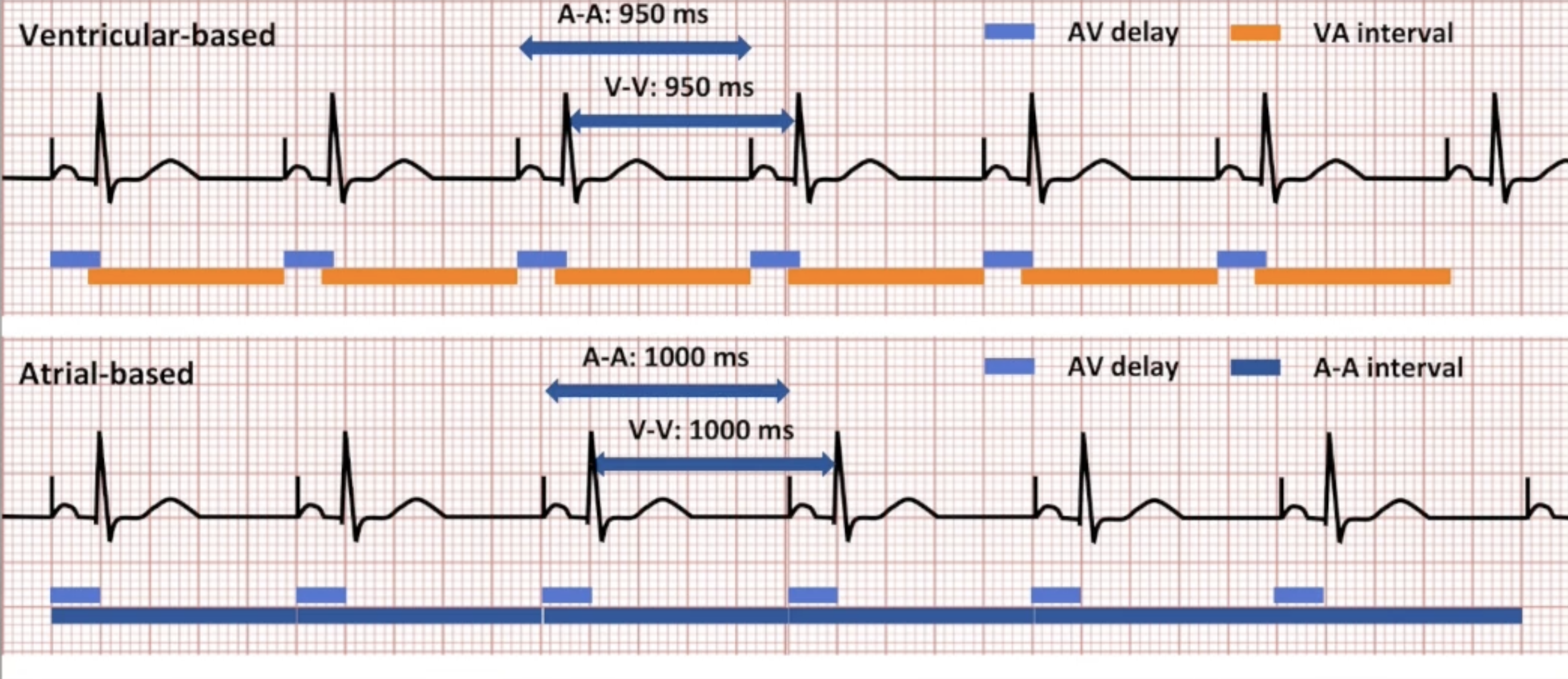 <p>Ventricle-based vs Atrial-based AP/VS diagram</p>