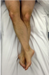 <p>1. superficial peroneal</p><p>2. sural </p><p>đź’ˇduring normal sleep, we move our bodies to prevenrt compression injury; the patient under general anesthesia can't change position & are at risk for nerve compression</p><p>đź’ˇif pt's legs remain crossed for prolonged period of time, there is risk of sural nerve compression in the top leg & superficial peroneal compression in the bottom leg</p>