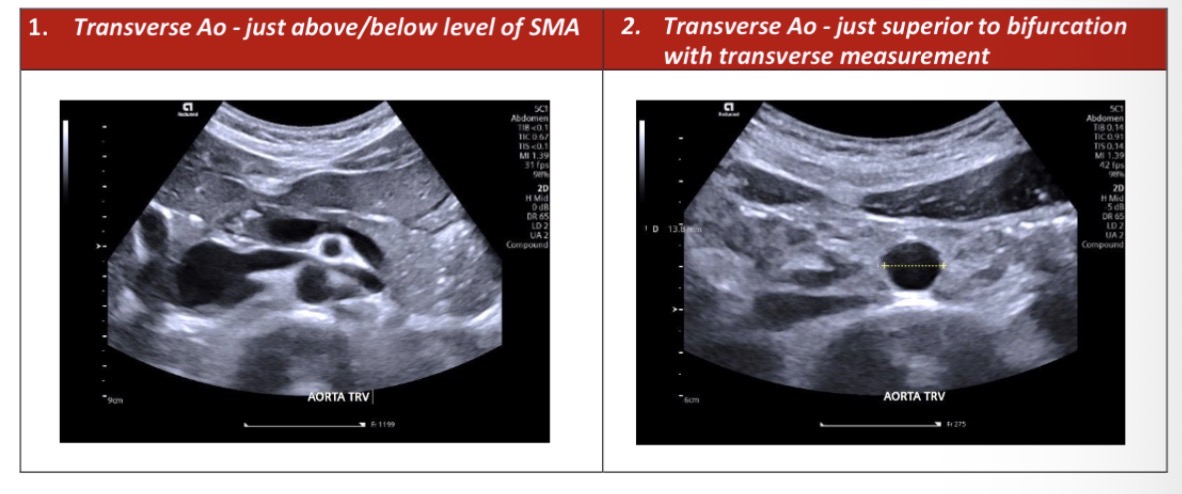 <p>Start in transverse plane place the probe under the xiphisternum and slightly to the right (and apply downward pressure to the illiac crest)</p><p>Identify the semicircular echogenic spine in order to locate the aorta as the largest central anechoic round structure anterior to the spine</p><p>To ensure its the correct structure locate the IVC to the left of the patient</p><ul><li><p>angle superiorly under the sternum towards the diaphragm ensure proximal portion of aorta is assessed, angle inferiorly again to starting position. Slide caudally again until you reach the sternum and then angle under the sternum the stream once more toward the heart</p></li></ul><p>Try to identify the coeliac axis and SMA watching signs of plaque or thrombosis or anyrsum</p><p></p>