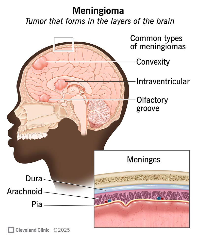 <ul><li><p>benign tumor of the meninges</p></li></ul><p></p>