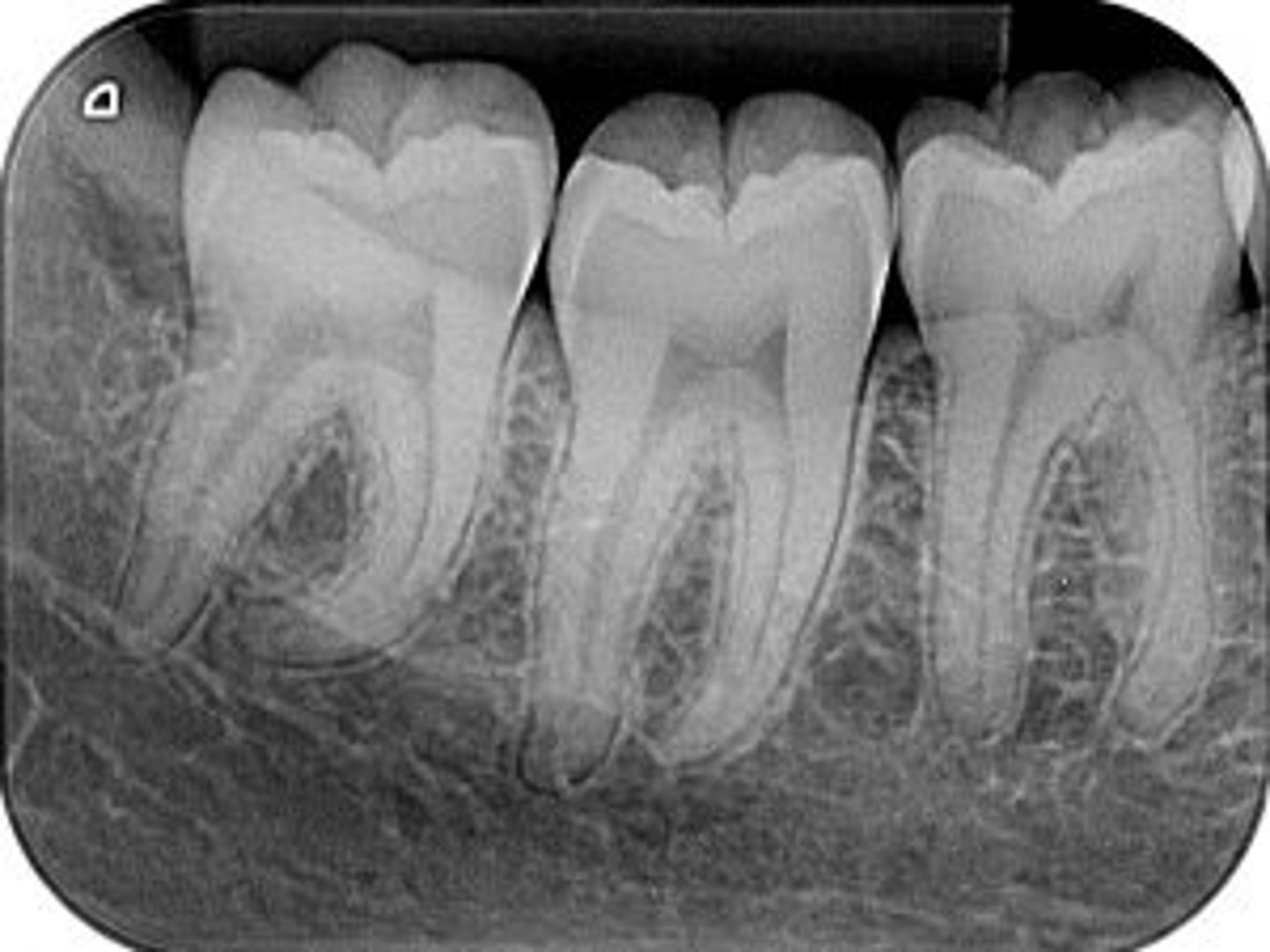 <p>radiographic image showing the crown, root tip, & surrounding structures</p>
