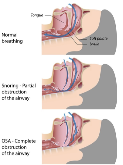 <p>Class I: no limitation</p><p>Class II: Loss of pillars</p><p>Class 3: loss of pillars and fauces</p><p>Class 4: Hard palate only</p>