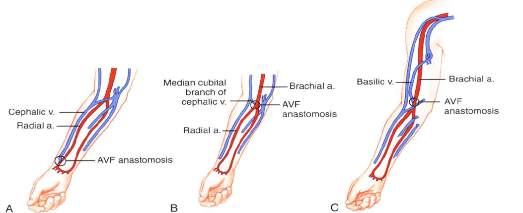 <p>brescia cimino (A) </p><ul><li><p>radial artery to cephalic vein</p></li></ul><p></p><p><strong>radial artery-basilic vein</strong></p><ul><li><p><strong>forearm transposition</strong></p></li></ul><p></p><p><strong>brachial artery to cephalic vein (B) </strong></p><ul><li><p><strong>antecubital area</strong></p></li><li><p>upper arm</p></li></ul><p></p><p>snuffbox fisutal</p><ul><li><p>branch radial artery - cephalic vein</p></li></ul><p></p><p>brachial artery to upper arm basilic vein transposition (C) </p><p></p><p>great saphenous, common fem or femoral vein</p><p></p><p>common femoral artery or superficial femo artery</p><p></p><p>axillary artery - axillary vien</p><p></p><p>axillary artery - ipsilateral or contralateral jugular vein</p><p></p><p>subclavian artery - contralateral subclavian vein</p><ul><li><p>“necklace graft”</p></li></ul><p></p><p></p>