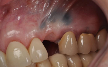 <p>amalgam traumatically introduced into mucosa; steel gray/ blue/ black macule; last indefinitely and may enlarge over time; no TX necessary but excision of very dark lesions may be warranted to rule out melanoma </p>