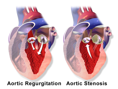 <p>4b Aortic, Systolic &amp; Diastolic murmur </p><p><span data-name="arrow_right" data-type="emoji">➡</span> Combined aortic stenosis and regurgitation</p>