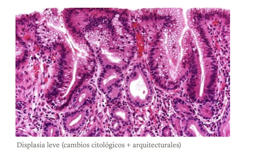 <p>ESÓFAGO DE BARRETT micro </p>