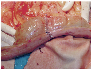 <p>Small intestinal Colic:TX</p>