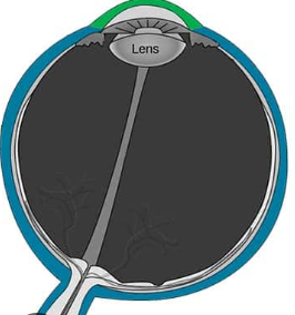 <p>The eye layer/tunic that consists of the cornea and sclera. <span>The sclera (white portion) consists of dense connective tissue containing blood vessels and nerves. The cornea is the transparent portion of the anterior aspect of the eye.</span></p>