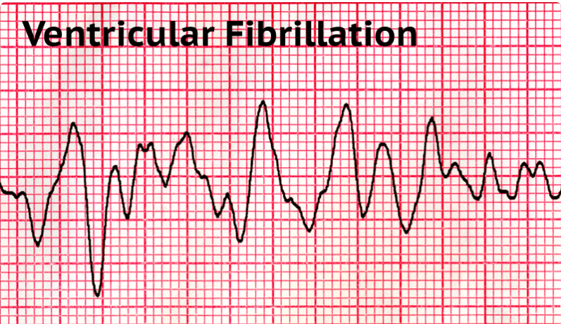 <p>Ventricular fibrillation </p>