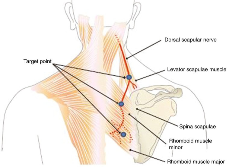 <p>Dorsal Scapular Nerve</p>