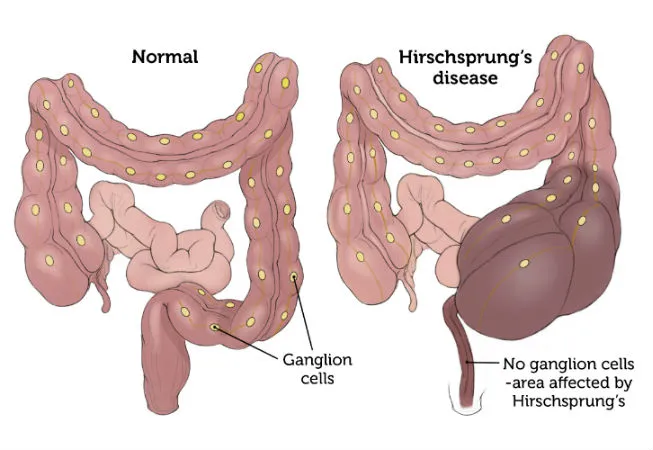 <p>Manifestations of Hirschsprung’s disease</p>
