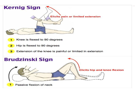 <p>Newborn:</p><p>-no illness present at birth, butit progresses w/i a few days</p><p>-manifestations are vague and hardest to diagnose</p><ul><li><p>poor muscle tone, weak cry, poor suck, refuses feeding, vomiting, diarrhea</p></li><li><p>possible fever or hypothermia</p></li></ul><p>-neck is supple w/o nuchal rigidity (early)</p><p>-bulging fontanels/nuchal rigidity are late signs</p><p>3mo- 2yo:</p><p>-seizures, fever, weak cry, irritability</p><p>-bulging fontanels, possible nuchal rigidity, poor feeding</p><p>-vomiting, Brudzinski’s sign and Kernigs sign are not reliable</p><p>2yo - Adolescence:</p><p>-seizures, nuchal rigidity, positive Brudzinski and Kernig signs</p><p>-fever and chills, headache, vomiting, irritability and restlessness</p><p>-petechiae or purpuric rash = does NOT blanche</p>