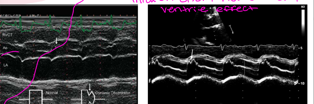 <p>what does this image tell you and during what cardiac cycle?</p><p></p><p><strong>The aortic valve opens normally, but when LVOT obstruction suddenly worsens in what cardiac cycle , forward flow ____, so the valve partially _____early and creates a ______on M-mode.</strong></p>