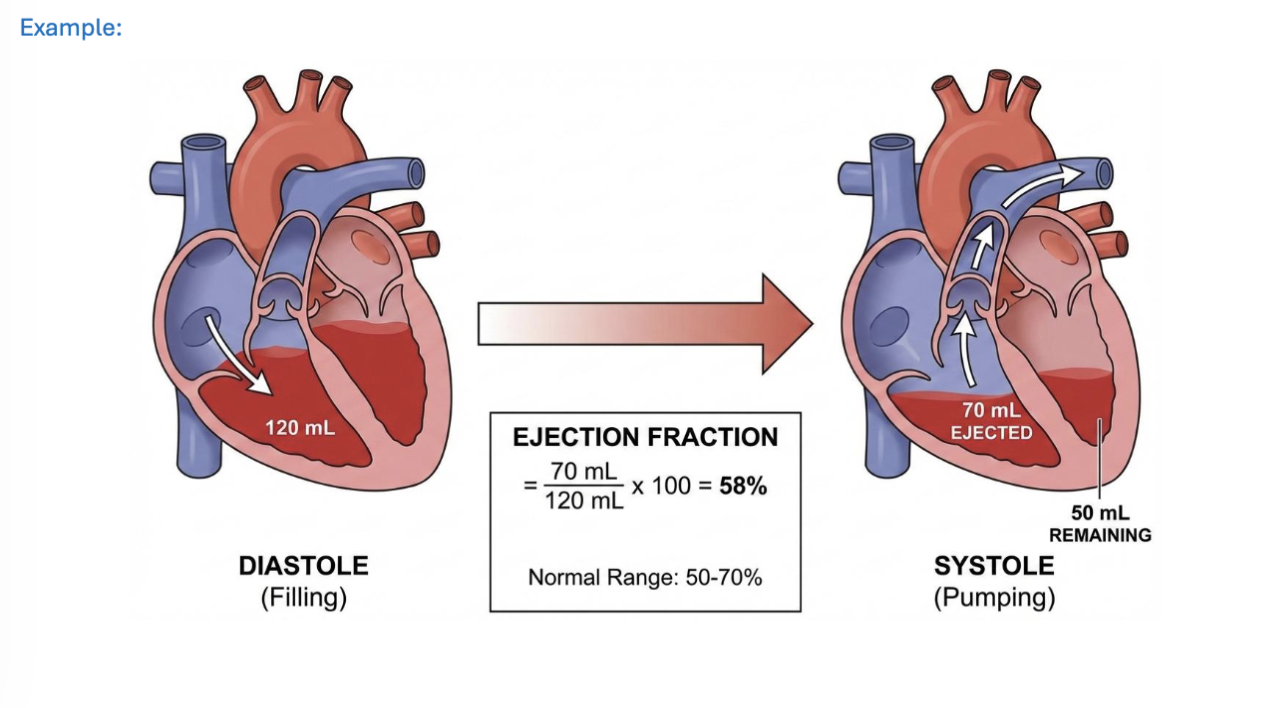 <p>ejection fraction (EF): the % of blood pumped out of the ventricles at every contraction- describes the efficiency of heart</p><p>EF normalizes SV for heart size by expressing it as % of EDV</p><p>avg EF is 50-70%</p><p>EF(%) = SV/EDV * 100</p><p>SV = EDV-ESV</p><p>—</p><p>heart failure (HF): heart’s inability to pump blood effectively to meet body needs</p><p>EF is used to classify HF into categories:</p><ul><li><p>HF with reduced ejection fraction (HFrEF) = impaired contractile function</p></li><li><p>HF with preserved ejection fraction (HFpEF)</p></li></ul><p></p>