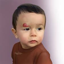 <p>facial hemangioma</p>