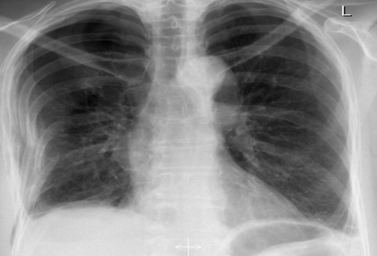 <p>Hidden area showing hiatal hernia</p>