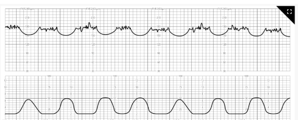 <p><mark data-color="#fffbce" style="background-color: rgb(255, 251, 206); color: inherit;">Nurse Interventions</mark></p><p>A nurse notices the FHR strip. What should the nurse do first</p>