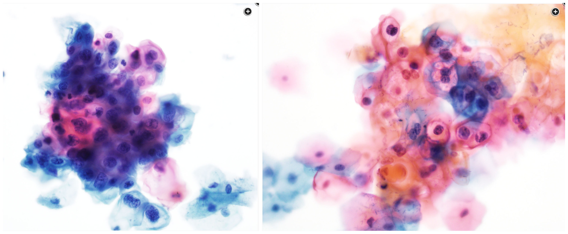 <p>50F pap smear - diagnosis</p>