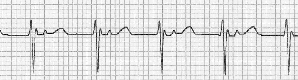 <p>Junctional rhythm (ECG)</p>