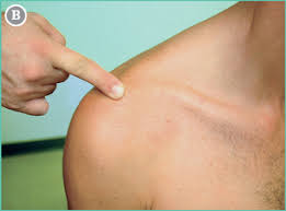 <p><strong>How to Palpate:</strong></p><ul><li><p>Begin at the sternoclavicular (SC) joint medially</p></li><li><p>Follow the clavicle laterally to the acromioclavicular (AC) joint.</p></li></ul><p></p><p>Confirm:</p><p>• Feel for the S-shaped curve and firmness of cortical bone.</p><p>• Identify widening or step-offs near AC joint.</p>