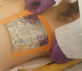 <p>aka "sucking chest wound" (can see lac of chest and airflow)</p><p>requires placement of occlusive dressing, overtop of wound, secured on 3 sides</p>