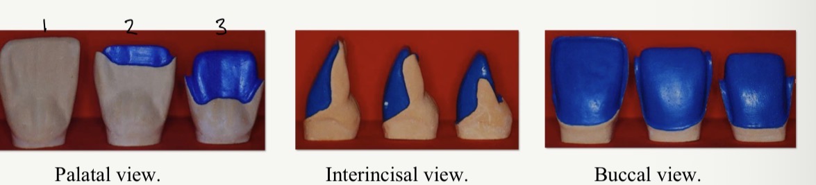 <p>Not exceed incisal edge (contact lens)</p><p>Exceeds incisal edge (classic type)</p><p>Widely exceeds incisal edge (three quarter type)</p>